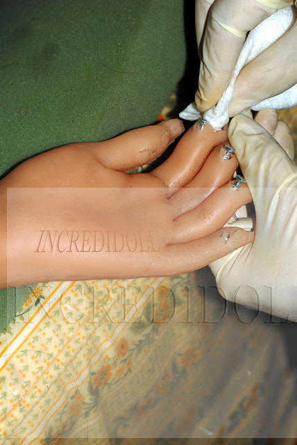 Finger repair (7b)