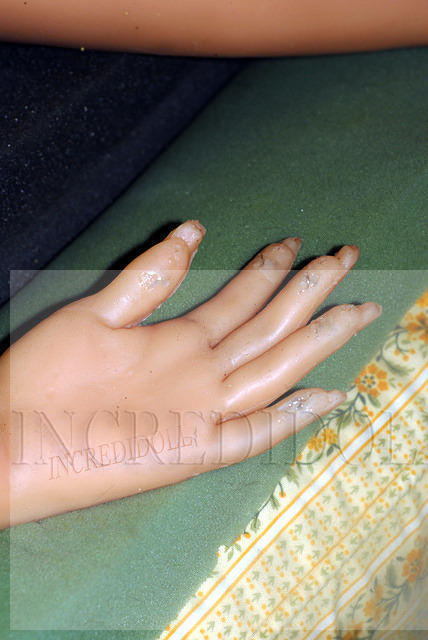 Finger repair (9b)